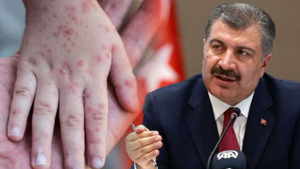 Artan kızamık vakalarıyla ilgili açıklama!